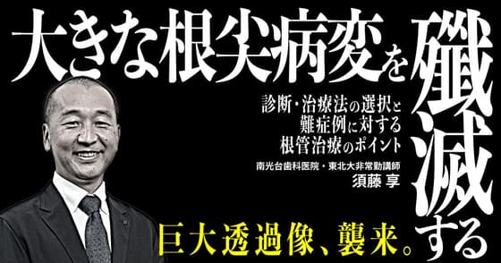 「大きな根尖病変」を殲滅する