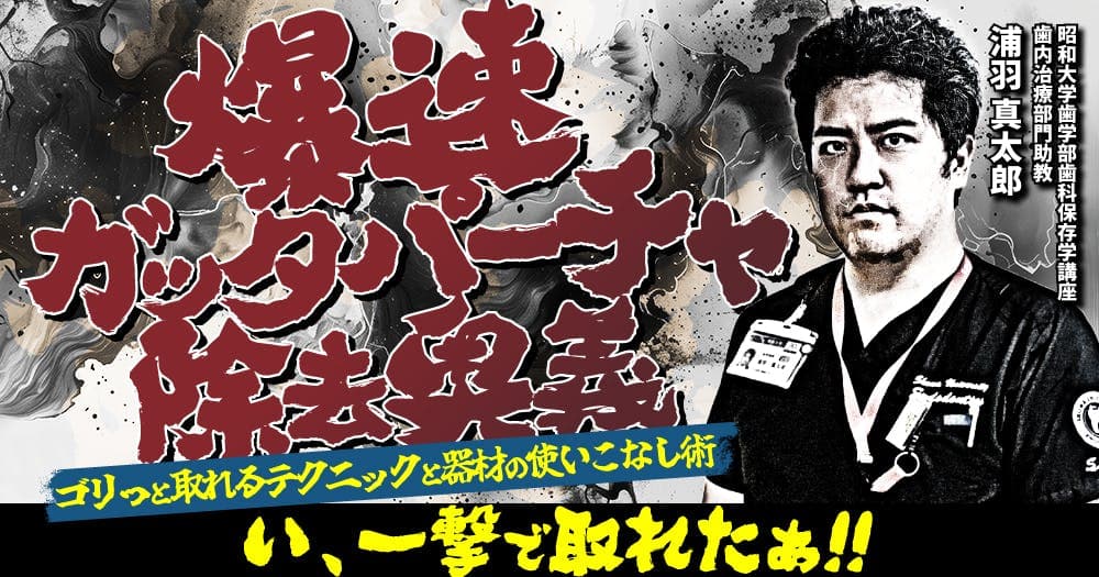 爆速ガッタパーチャ除去奥義
