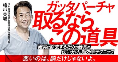 ガッタパーチャ取るならこの道具