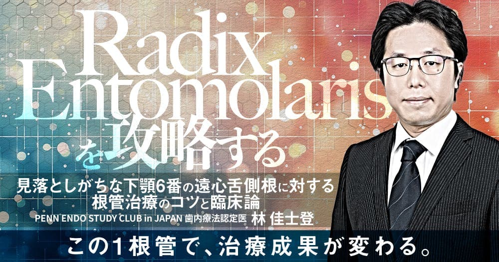 Radix Entomolarisを攻略する - 見落としがちな下顎6番の遠心舌側根に対する根管治療のコツと外科治療症例