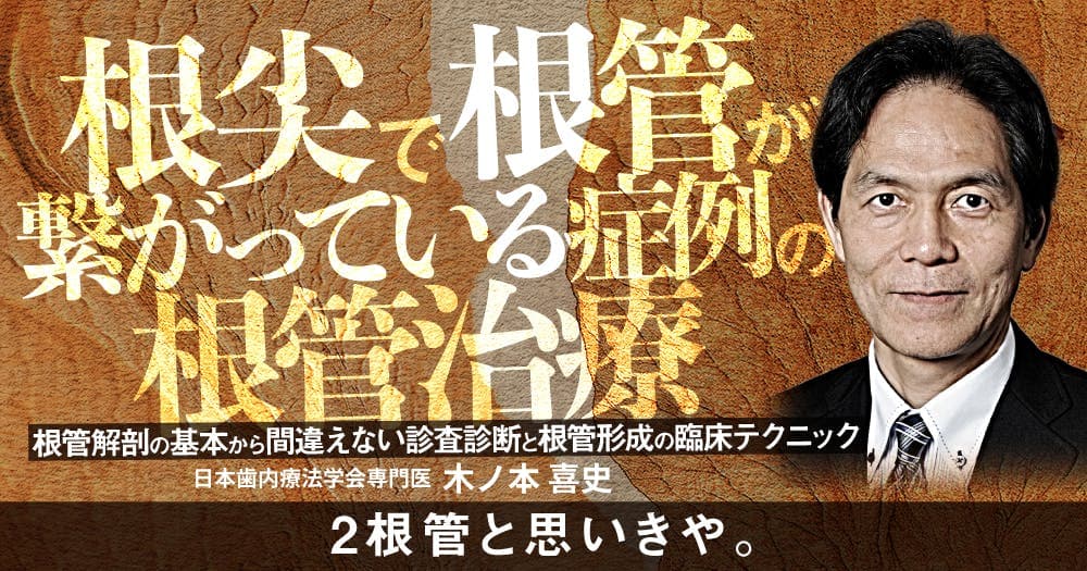 根尖で根管が繋がっている症例の根管治療 - 根管解剖の基本から間違えない診査診断と根管形成の臨床テクニック