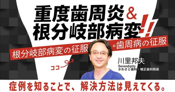 重度歯周炎&根分岐部病変の臨床