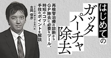 はじめての「ガッタパーチャ除去」