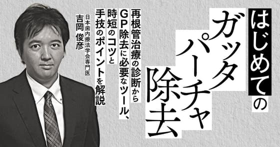 はじめての「ガッタパーチャ除去」