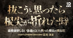 抜こうと思ったら根尖が折れた時