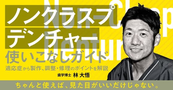「ノンクラスプデンチャー」使いこなしガイド