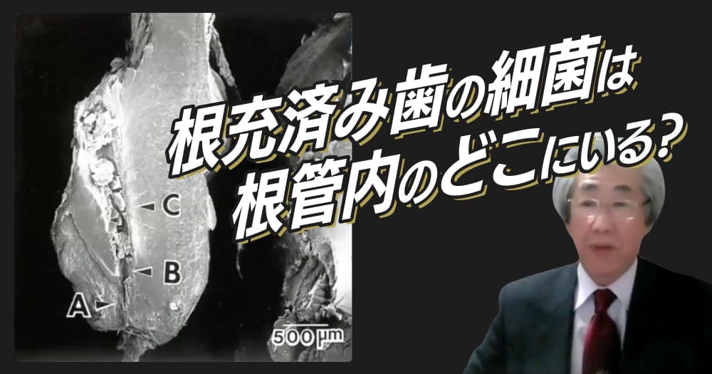 【切り抜き】再根管治療におけるガッタパーチャ除去のポイント - 道具がなくても腕で乗り切るテクニック