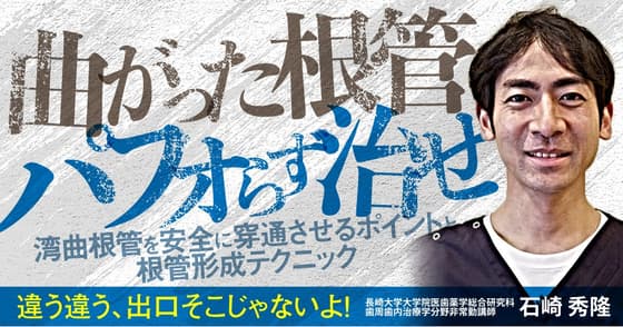 曲がった根管パフォらず治せ