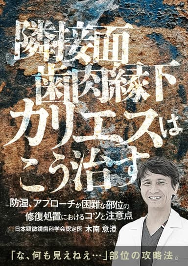 ランキング1位の「隣接面歯肉縁下カリエス」はこう治す
