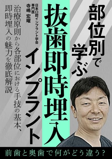 ランキング13位の部位別で学ぶ「抜歯即時埋入」インプラント