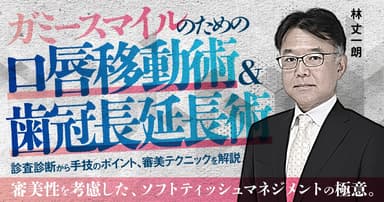 ガミースマイルのための口唇移動術＆歯冠長延長術