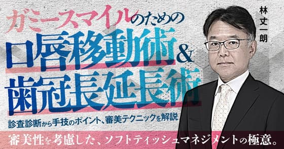 ガミースマイルのための口唇移動術＆歯冠長延長術
