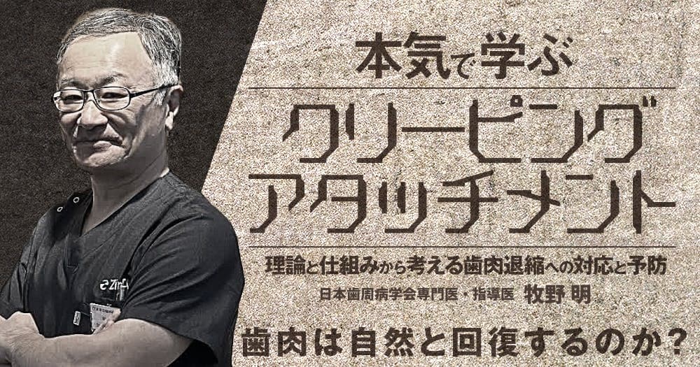 本気で学ぶ「クリーピングアタッチメント」 - 理論と仕組みから考える歯肉退縮への対応と予防