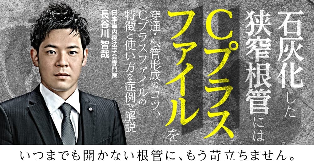 石灰化した狭窄根管には「Cプラスファイル」を - 穿通・根管形成のコツ、Cプラスファイルの特徴と使い方を症例で解説