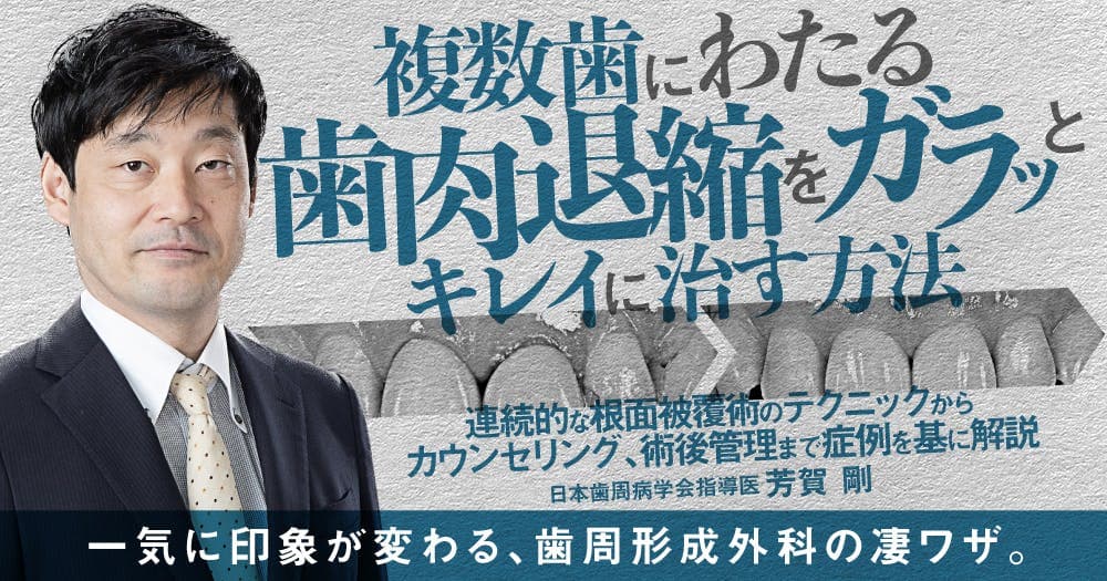 複数歯にわたる歯肉退縮をガラッとキレイに治す方法 - 連続的な根面被覆術のテクニックからカウンセリング、術後管理まで症例を基に解説