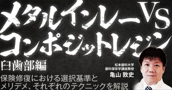 メタルインレー vs コンポジットレジン ＜臼歯部編＞
