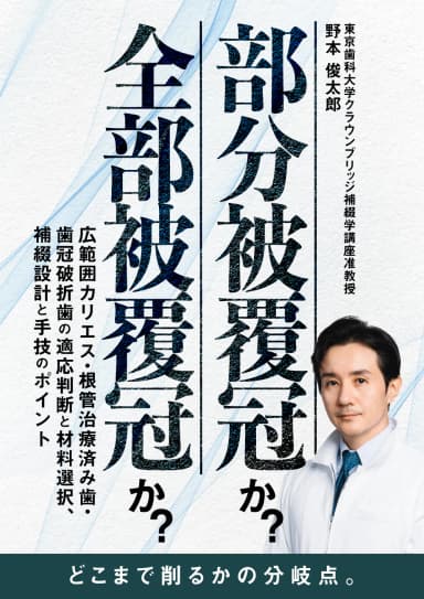 ランキング8位の部分被覆冠か？全部被覆冠か？