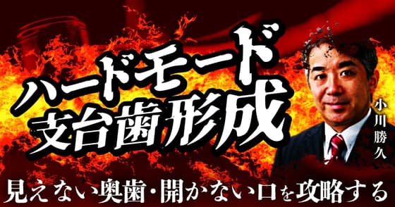 ハードモード支台歯形成