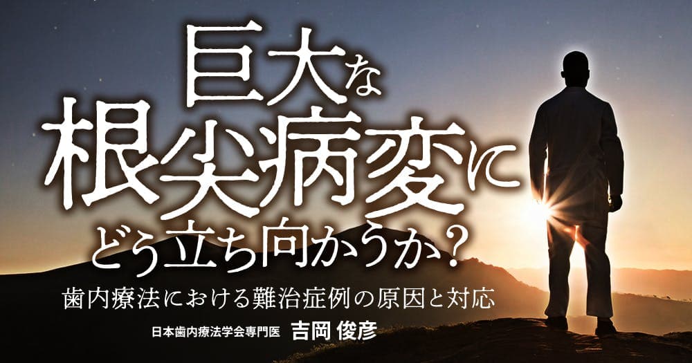 巨大な根尖病変にどう立ち向かうか？ - 歯内療法における難治症例の原因と対応