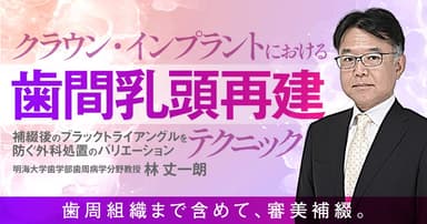 クラウン・インプラントにおける歯間乳頭再建テクニック