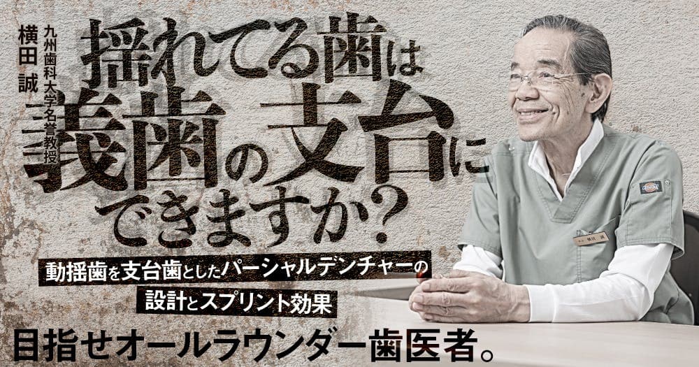 揺れてる歯は義歯の支台にできますか？ - 動揺歯を支台歯としたパーシャルデンチャーの設計とスプリント効果