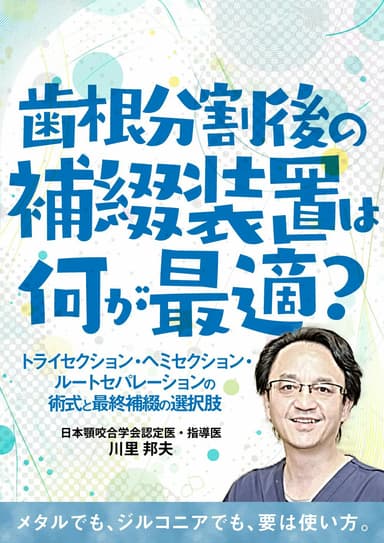 ランキング17位の歯根分割後の補綴装置は何が最適？
