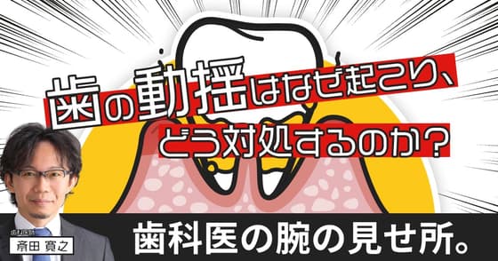 歯の動揺はなぜ起こり、どう対処するのか？