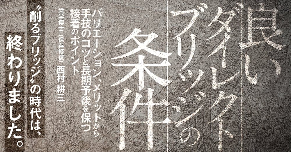 良いダイレクトブリッジの条件 - バリエーション、メリットから手技のコツと長期予後を保つ接着のポイント
