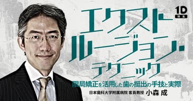 エクストルージョン・テクニック