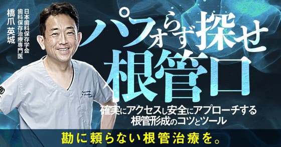 パフォらず探せ根管口