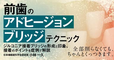前歯の「アドヒージョンブリッジ」テクニック