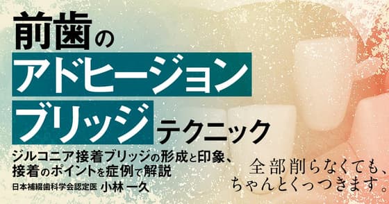 前歯の「アドヒージョンブリッジ」テクニック