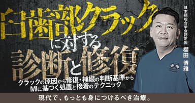 臼歯部クラックに対する診断と修復