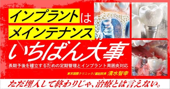 インプラントは「メインテナンス」がいちばん大事