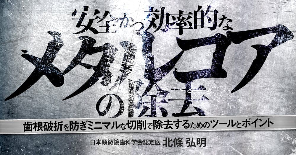 安全かつ効率的なメタルコアの除去 - 歯根破折を防ぎミニマルな切削で除去するためのツールとポイント