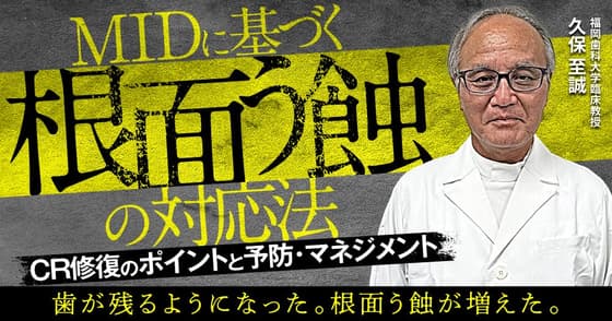 MIDに基づく「根面う蝕」への対応法