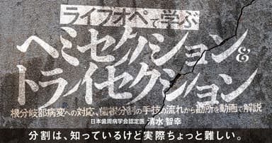 ライブオペで学ぶ「ヘミセクション&トライセクション」