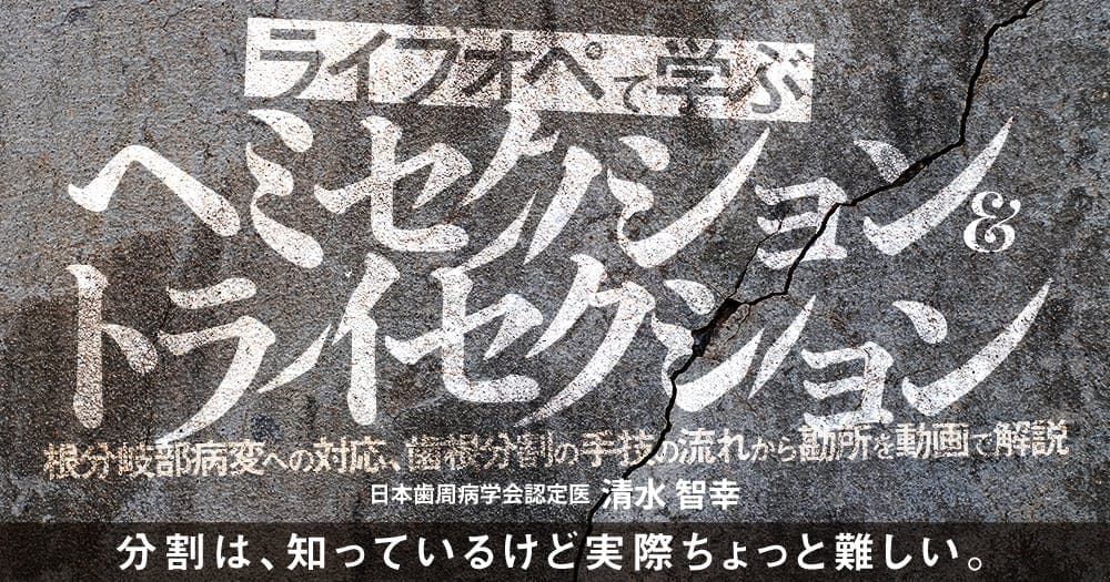 ライブオペで学ぶ「ヘミセクション&トライセクション」 - 根分岐部病変への対応、歯根分割の手技の流れから勘所を動画で解説