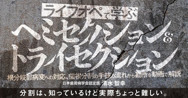 ライブオペで学ぶ「ヘミセクション&トライセクション」