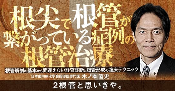 根尖で根管が繋がっている症例の根管治療