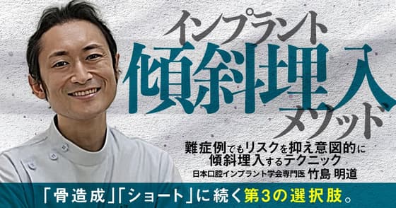 インプラント傾斜埋入メソッド