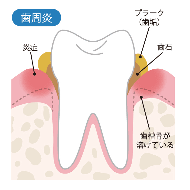 プロービングとは？検査方法も解説｜1D（ワンディー）