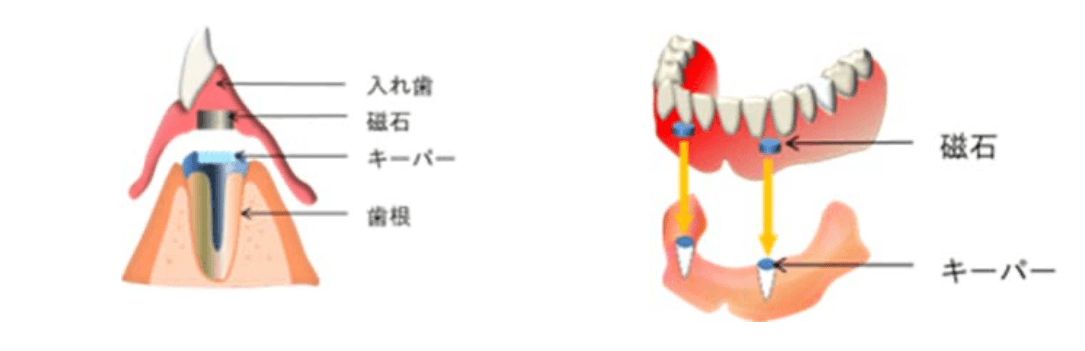 新・磁性アタッチメント 磁石を利用した最新の補綴治療 - 健康/医学