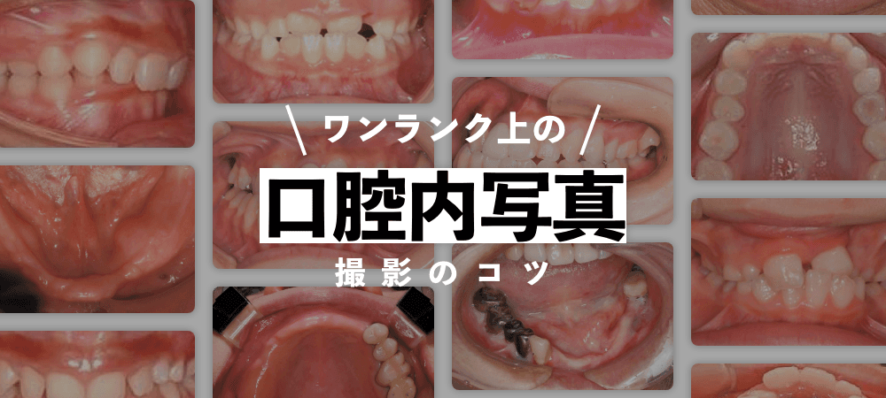 ワンランク上の口腔内写真撮影のコツ