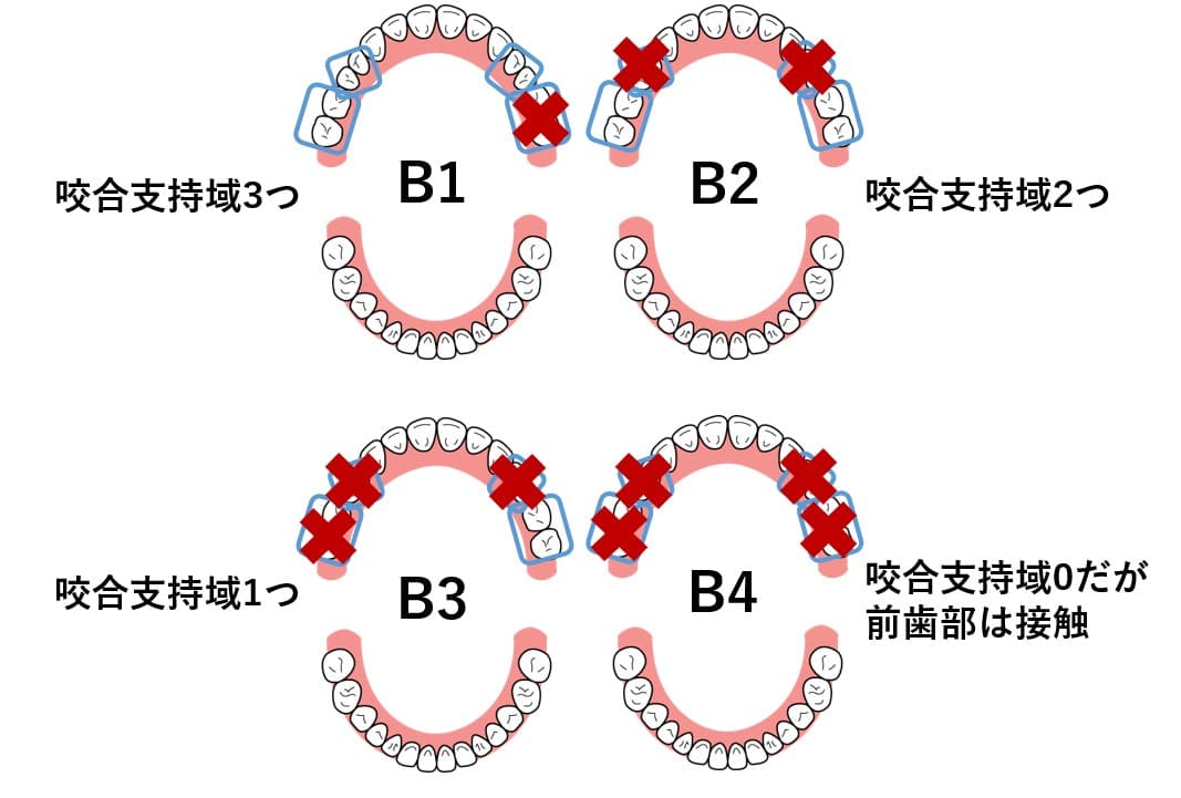 Eichnerの分類(アイヒナーの分類)|歯科オンラインセミナー・録画配信は1D(ワンディー)