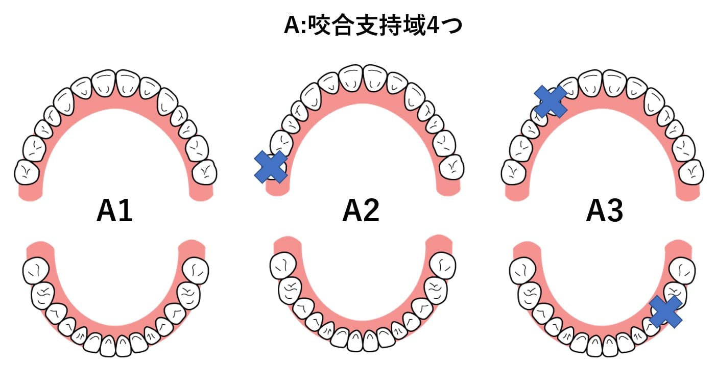 Eichnerの分類(アイヒナーの分類)|1D(ワンディー)